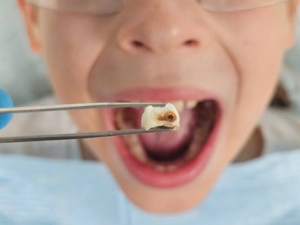 Best Emergency Treatment for Dental Infections or Abscesses in Halfway, MD
